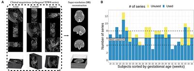 Fetal Brain Biometric Measurements on 3D Super-Resolution Reconstructed T2-Weighted MRI: An Intra- and Inter-observer Agreement Study